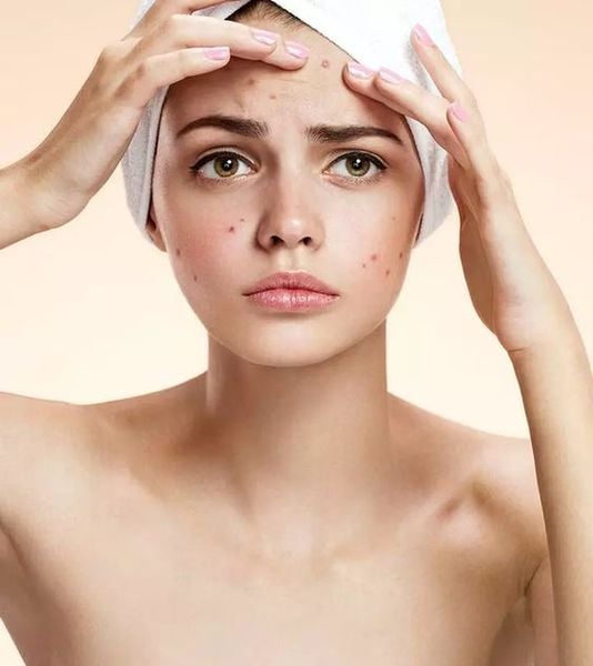 Hướng dẫn cách chọn nước hoa hồng cho da dầu mụn chuẩn chuyên gia